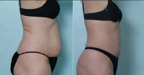 laser liposuction surgery mini-invasive laser surgery melting fat slimming lipolysis laser