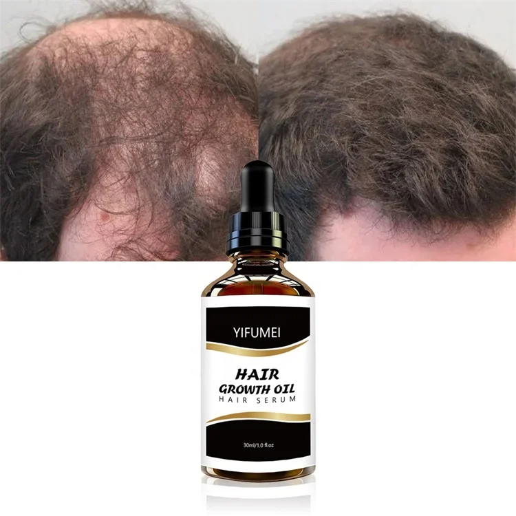 Private Label Ginseng Black Sesame Oil Regrowth Bald Hair Growth Oil Serum For Hair Loss Scalp Treatment