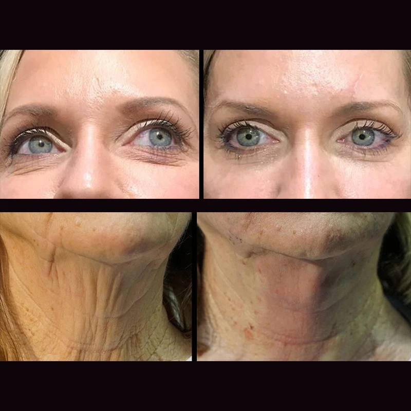 korean absorbable suture aptos thread lift silhouette soft beauty skin care pdo 3d 4d cog pdo thread face lift