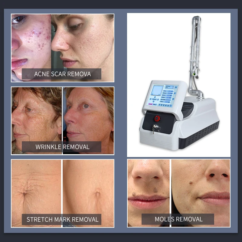 60w co2 fractional laser 4D skin scar/stretch marks removal skin resurfacing vaginal tightening beauty machine with ce