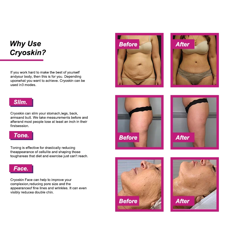 Beauty salon cryoskin crioterapia cold compression therapy cryotherapy cryo slimming tshocks t shock lipolysis machine cryoslim