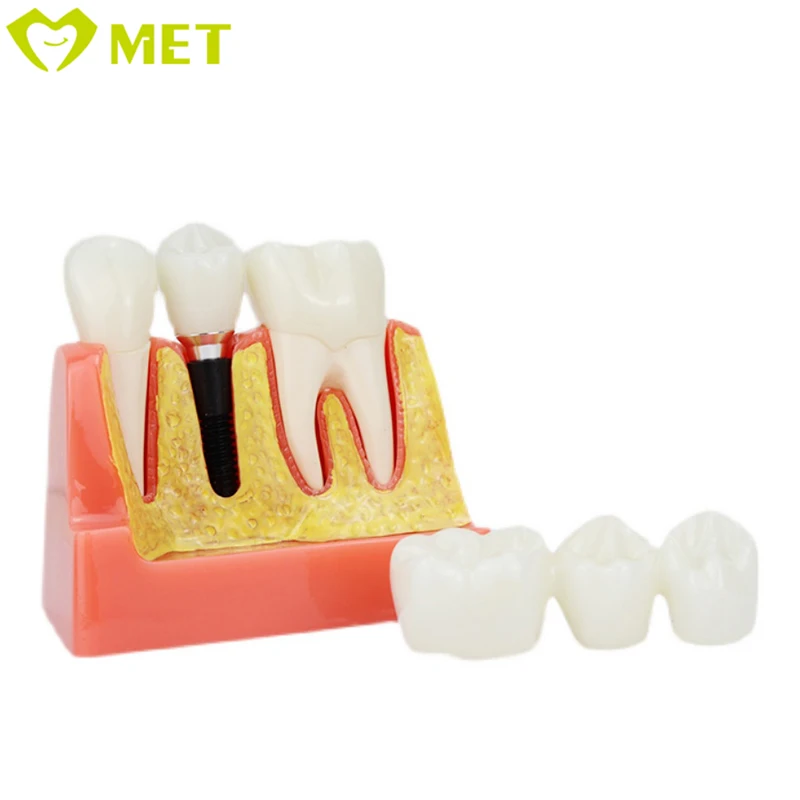 Meite medical 4 Times dental implant model/dental teaching model/dental removable teeth model