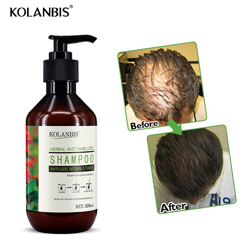 Private Label Hair Loss Shampoo Manufacturer KOLANBIS Hair Growth Products