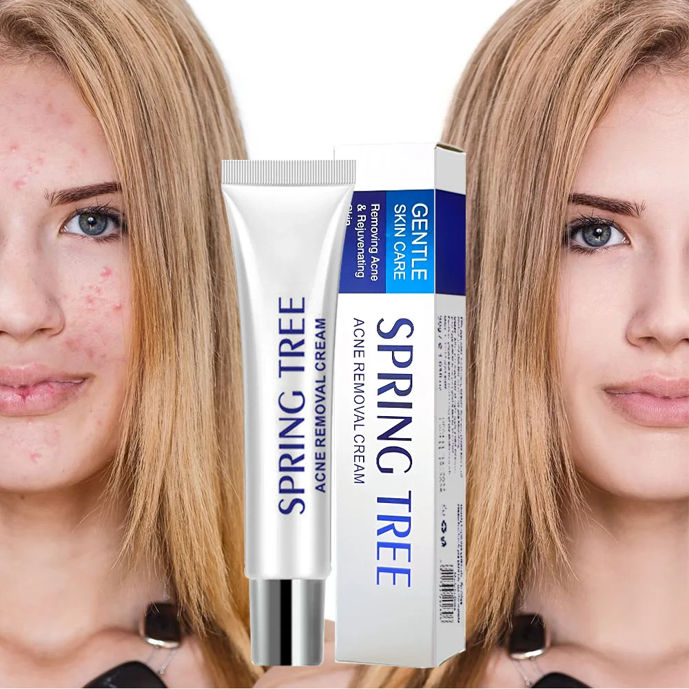 Private Label pimples Removal Face Acne Treatment Anti Acne Cream For Acne Face Cream