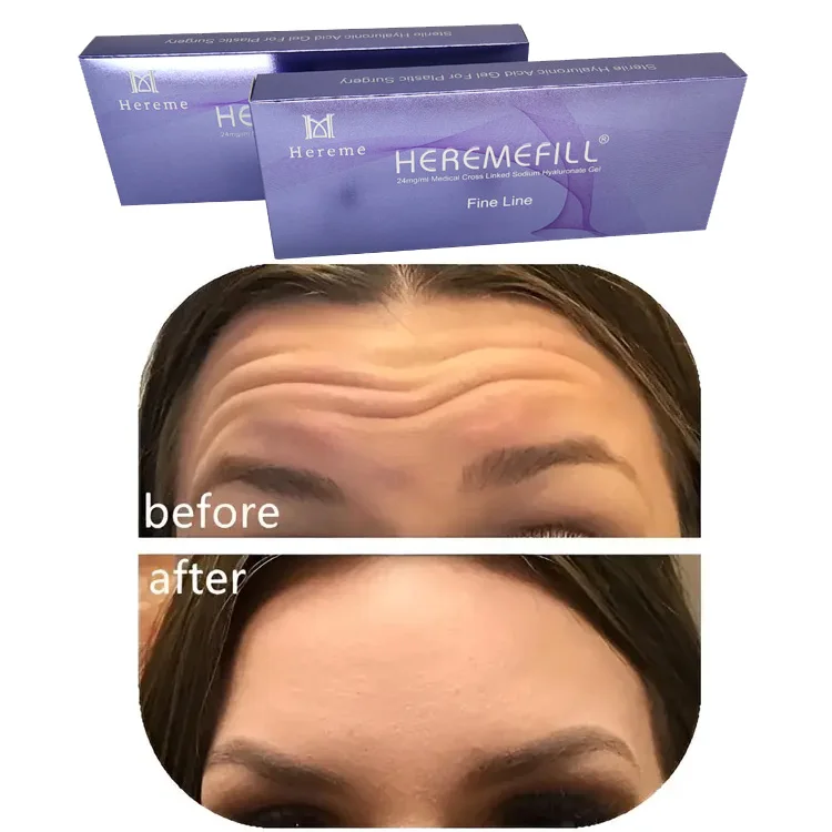 Heremefill  Injecting cross-linked gel hyaluronic acid skin filling facial filler facial wrinkles