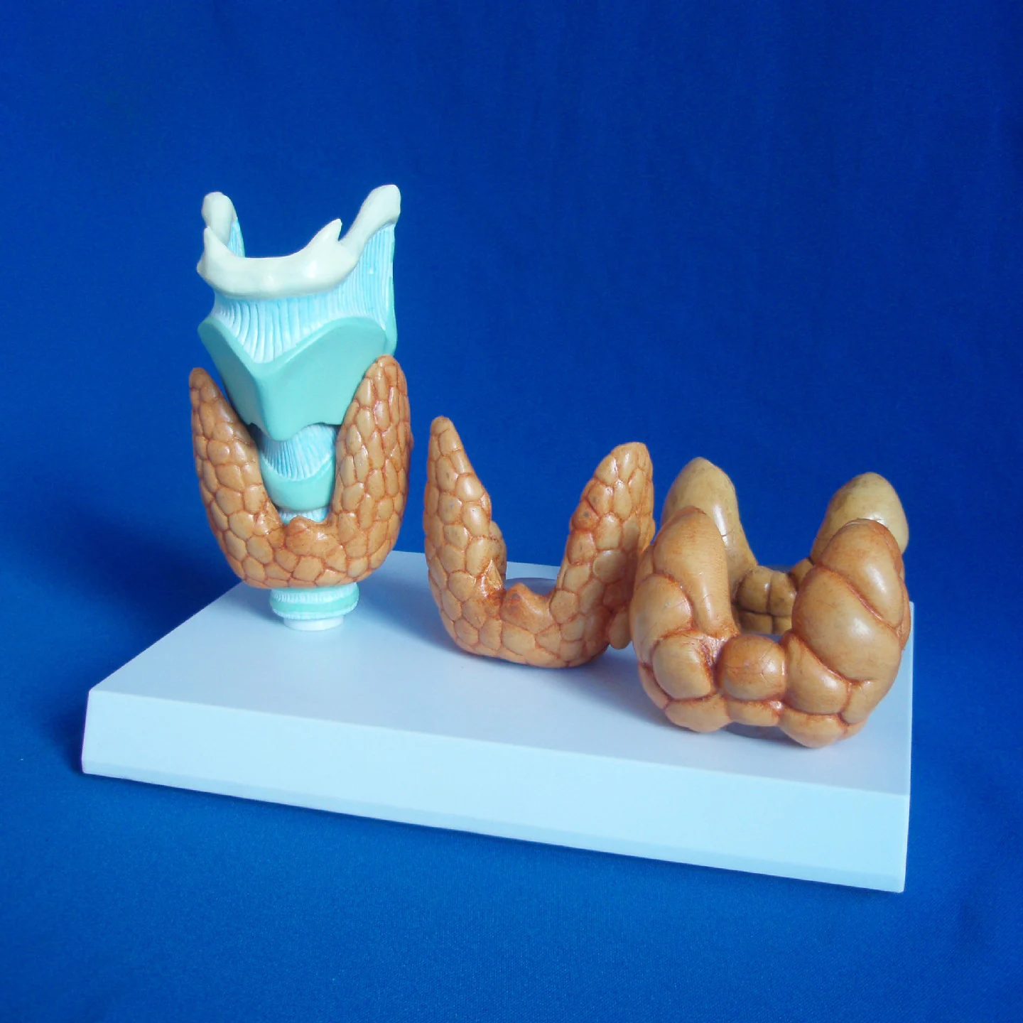 Human Throat Thyroid Pathological Model Thyroid Disease Anatomical Model