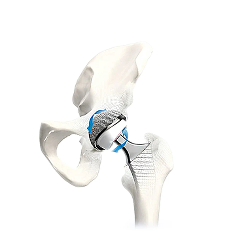 Hip Prosthesis Manufacturer HA Coating  Long Cementless Femoal Stem for Hip Joint Surgery