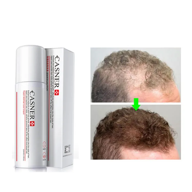  Спрей CASNER для лечения волос лечение Alopecia помогает здоровому росту сыворотка семейного повседневного использования мужчин и