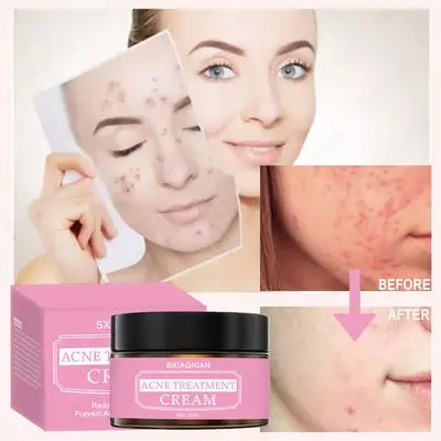 SXIAGNIAN  Natural Fast Effective High Quality Benzoyl Peroxide 10% Anti Acne Face Cream