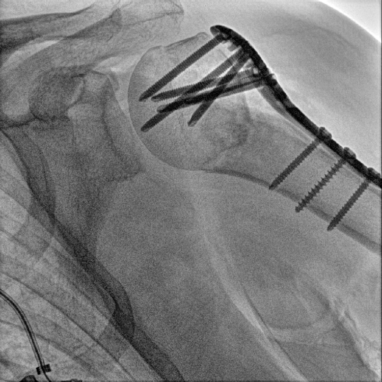 40kHz  c arm x ray orthopedic mobile x ray