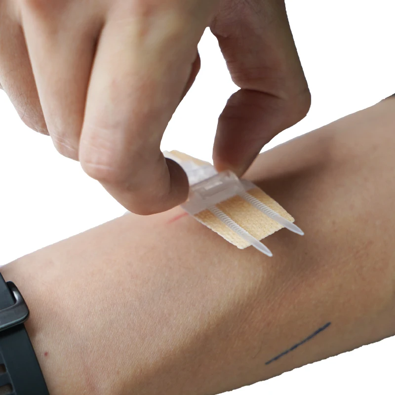 Medical Non-Woven Article Wound Closure Steri-Strip For Emergency Laceration Closures Topical Adhesive Zipper Wound Skin Closure