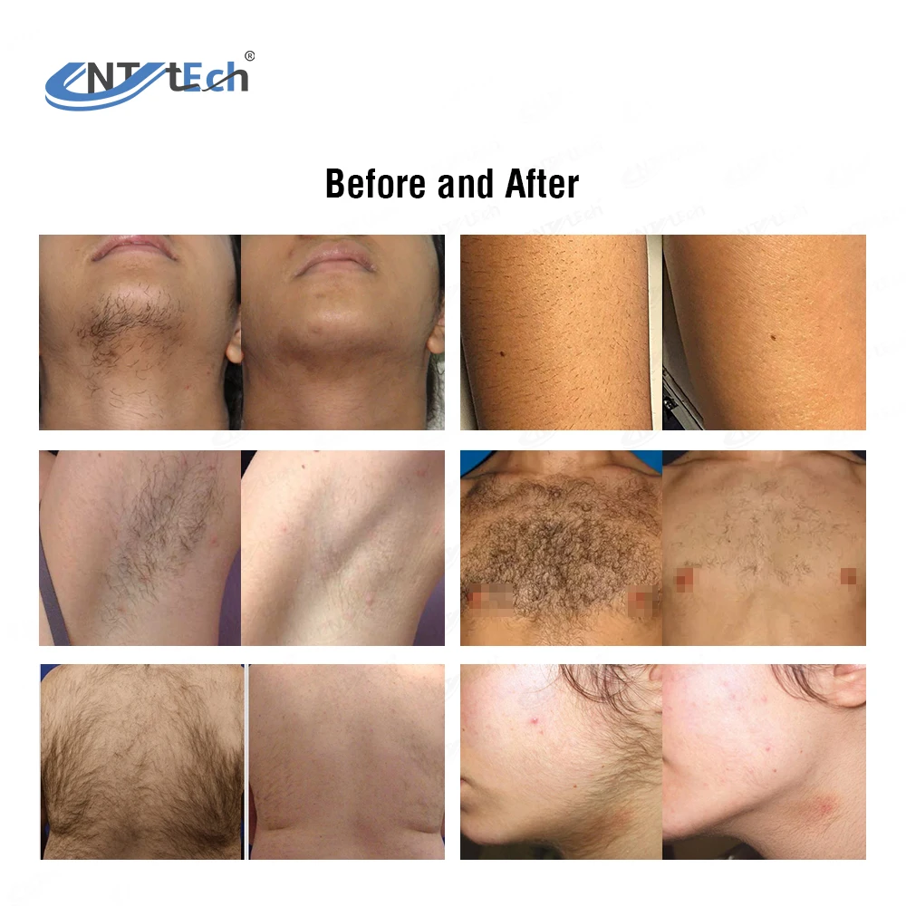 Vertical or portable painless 3 waves diode laser for hair removal 808nm machine