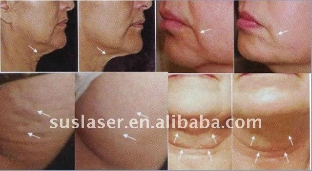 
Fat loss ultrasonic cavitation machine portable rf skin tightening machine fat reduction 