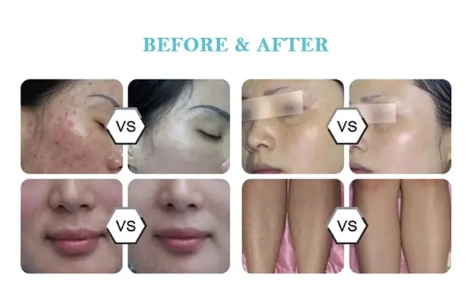 Perfect multifunction device for just opened business, laser hair removal, skin rejuvenation and pigments removal 3 in 1