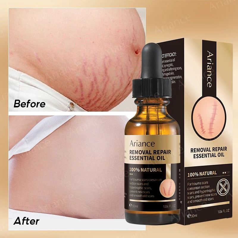 ODM OEM custom supplier Essential Oil Stretch Mark Body Pregnancy Scars Remove Essential Oil