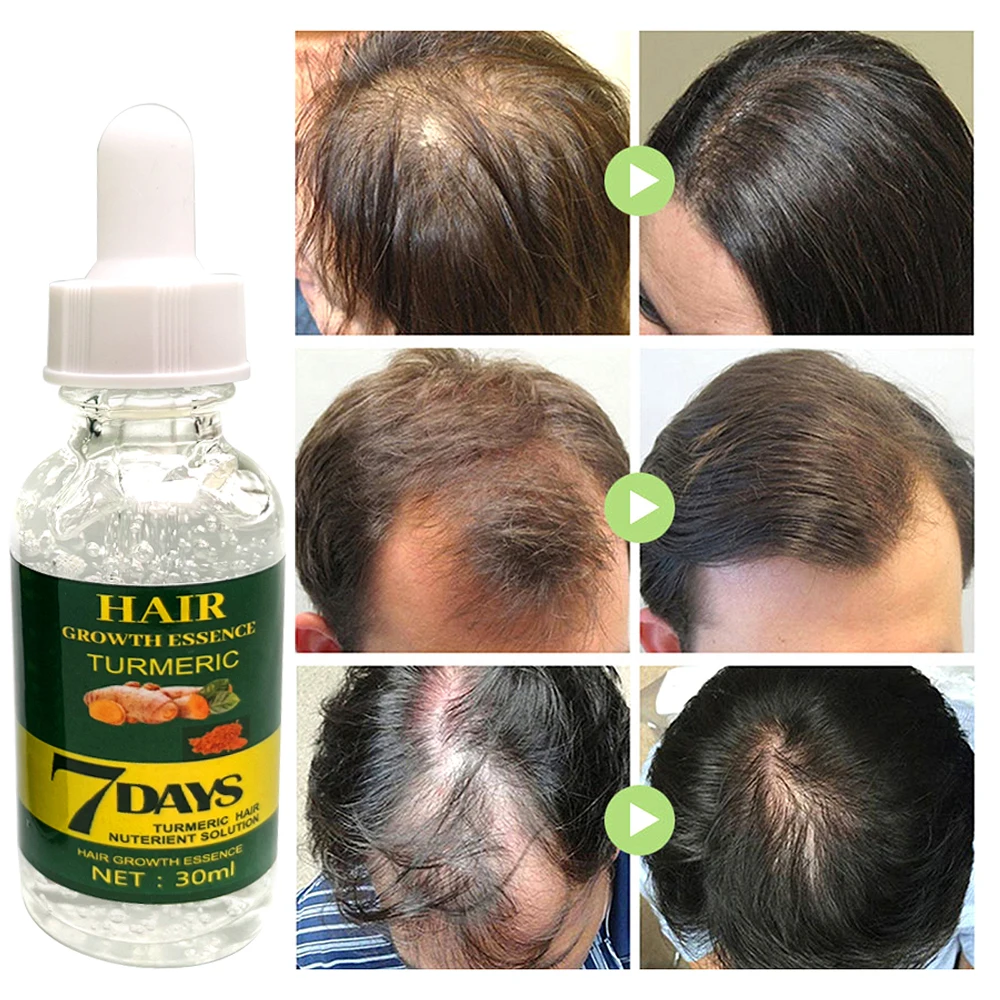 Private Label Natural Organic Vegan Treatment for Bald Hair Serum Wholesale Herbal Anti Hair Loss Boosting Hair Growth Oil