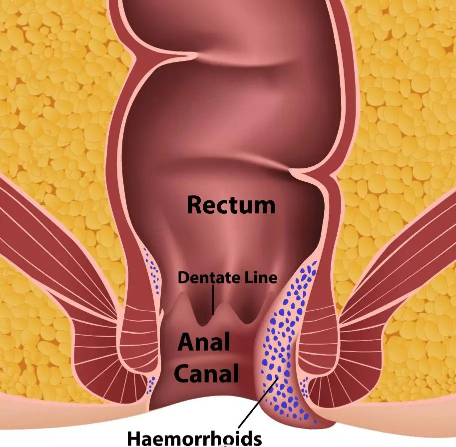 980nm 1470nm anal manometry laser proctology laser for hemorrhoids