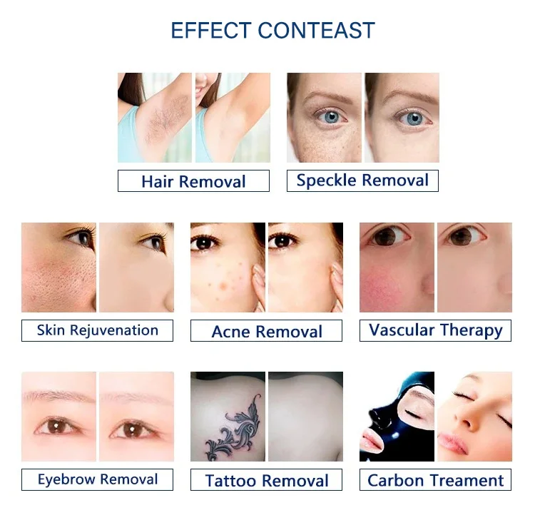 4 In1IPL RF radio frequency hair removal picosecond nd yag laser tattoos pigmentation removal beauty equipment