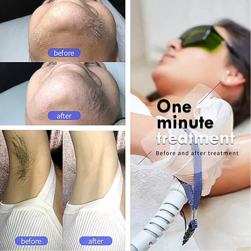 Beauty Instrument Titanium Triple Diode Laser Hair Removal 755 808 1064 Laser Hair Removal Machine