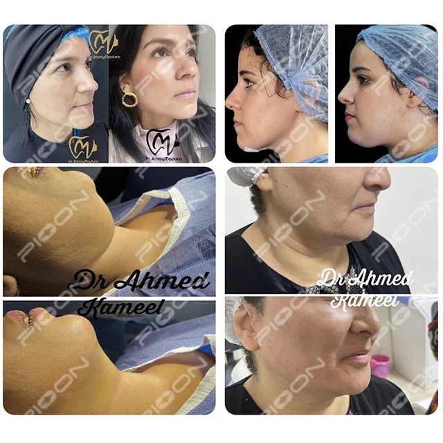 2024 PIOON Liposuction Endolifting Diode Laser Machine 1470nm 15W Face Lifting Endolaser 200μm Bare Fiber