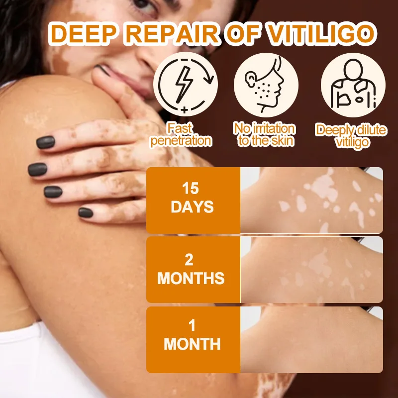 HBESTY Effectively Remove Vitiligo Ointment Remove Ringworm White Spot and Vitiligo Skin Care Product