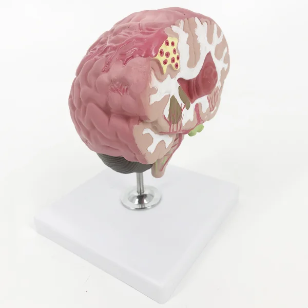 BMN/N051 Brain Stroke Model (Brain Disease Model)