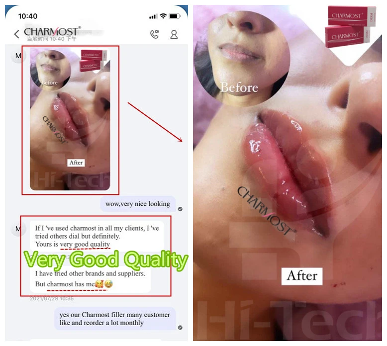 CHARMOST CE ISO lip injections gel buy hyaluronic acid dermal filler injection 2cc