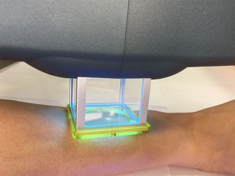 CE 308nm excimer laser psoriasis vitiligo physical therapy solution laser therapy