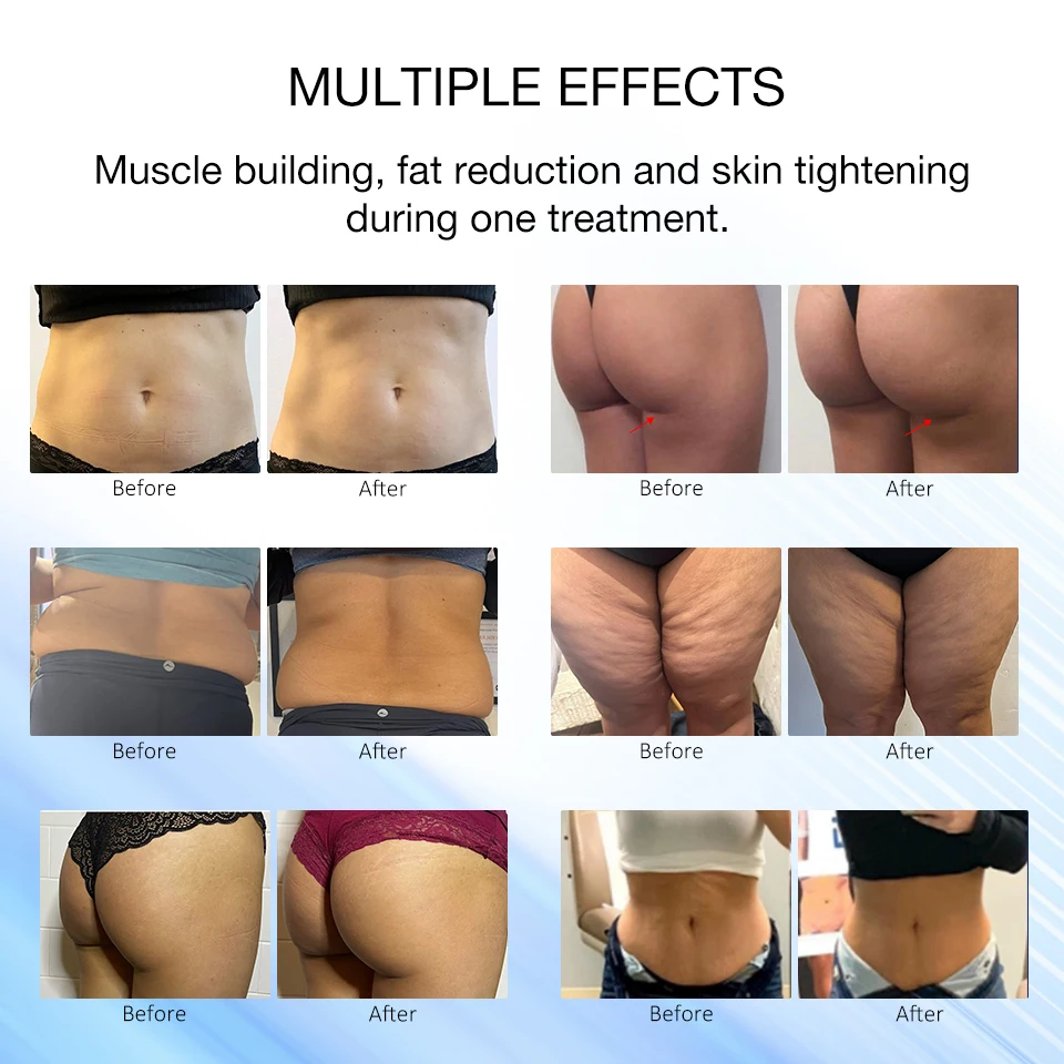 2024 New Ems 15 Telsa 5 Handle Weight Loss Ems Machines