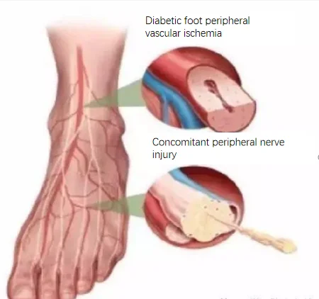 Advanced medical home use Portable Interference electrotherapy physiotherapy machine for promote tissue healing