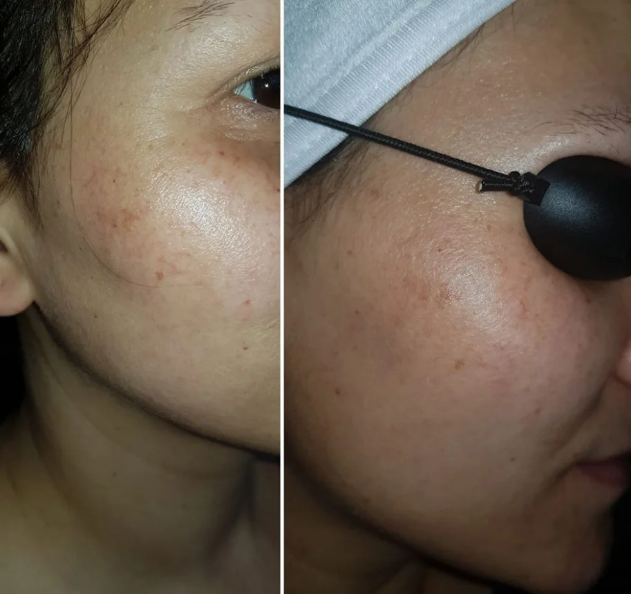 Picosur Laser ND Yag Tatoo Remove Laser Picosecond Pigmentation Removal Machine