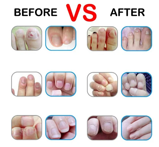 Nail Fungus Repair Treatment Pen Products Onychomycosis Paronychia Anti Fungal Nail Infection Chinese Herbal Care Oil Pen