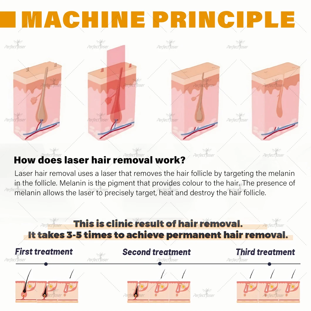 808nm Laser Hair Removal Machine Professional Ice Titanium 3500W Big Powwer Permanently Diode Laser Hair Removal Machine