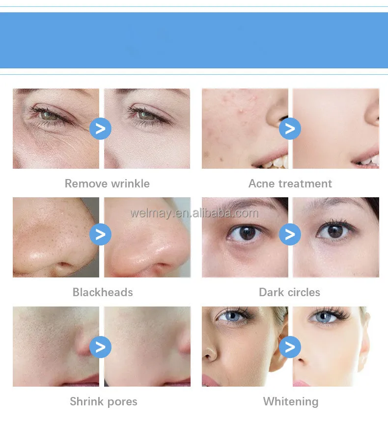 Factory Best Blackhead Remover Hydradermabrasion Oxygen Infusion Oxygen Spray And Microdermabrasion Peeling machine