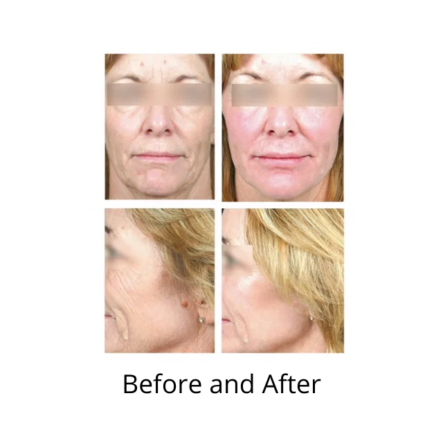 3 in 1 Complex Light Filler Effect Boosts Skin Rejuvenation and Elasticity ONmacabim ON-3B Solution