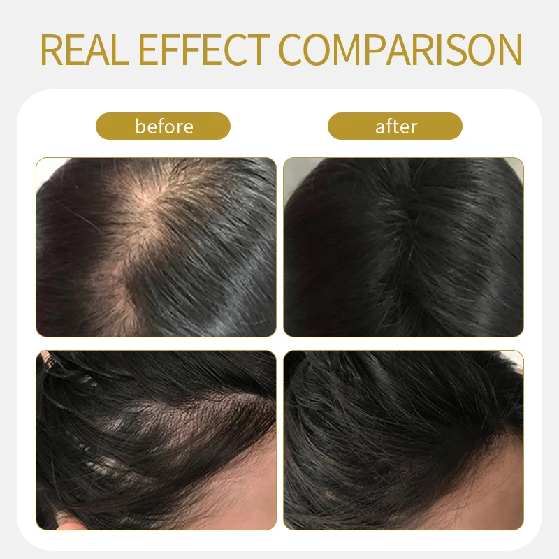 1 liter Hair Care Treatment  hair growth Oil agent Prevents Hair Loss Nourishing Growth Serum