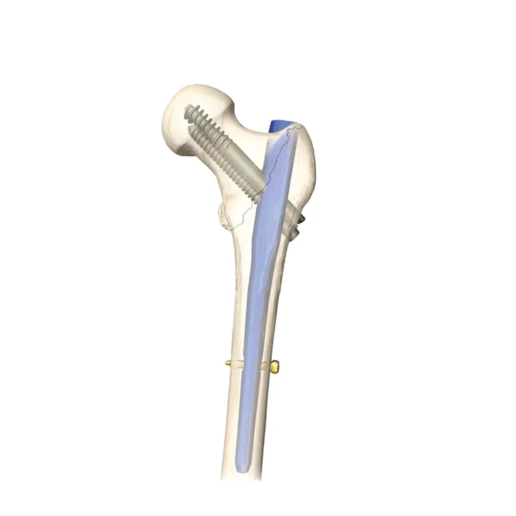 CareFix femur and tibia Interlocking nail,Metallic Intramedullary Nail