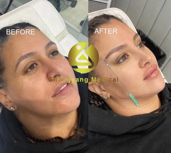 Korea plla screw threads face lifting thread pdo plla pcl cog thread nose profhilo neuramis filler rejueness