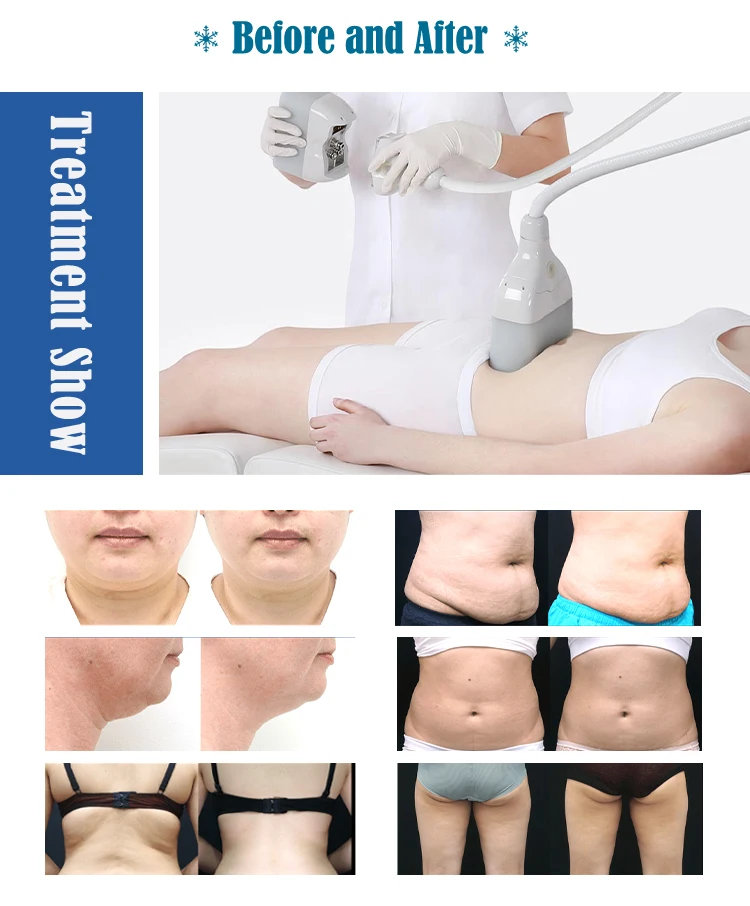 Aesthetic 360 Degree Cryo Slimming Machine Cellulite Reduction Big Coverage 7 Heads Criolipolisis 360 Fat Freezing Machine