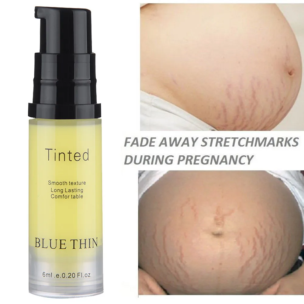 Postpartum Body Fading Stretch Marks Repair Obesity Removal