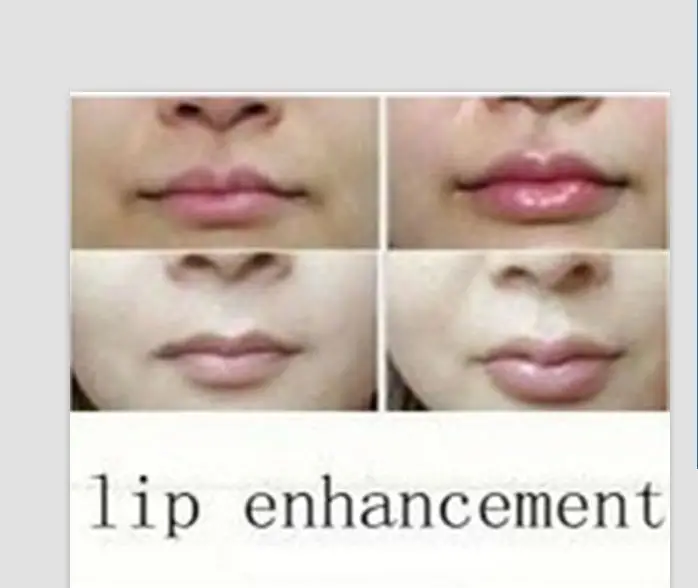 2 мл Derm line acido hialuronico injectable/hialuronico кислота дермальный наполнитель