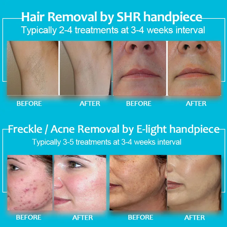 KES Most popular beauty equipment new style SHR / OPT / IPL+elight+ RF Multifunctional ipl depilacion laser opt shr