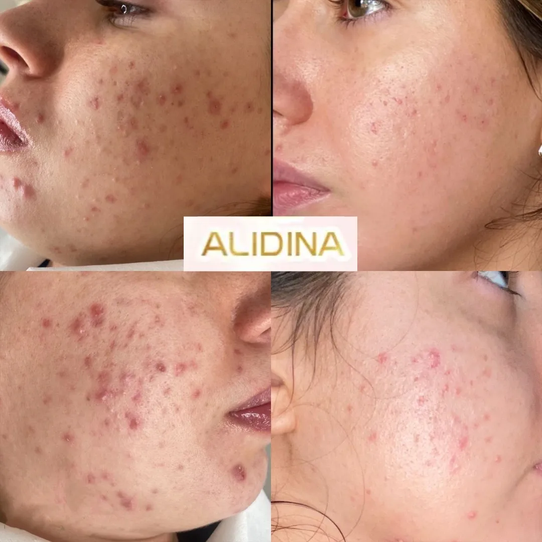 Биомикронидлинг Spongilla Spicules биомикронидлинг терапия акне удаление водорослей шелушение натуральные водоросли отслаивание маска порошок
