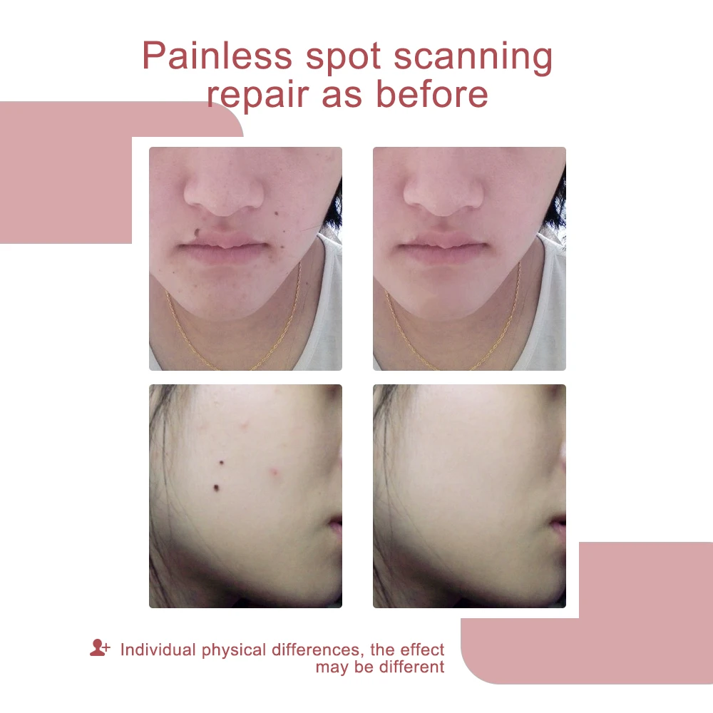 Best Price Laser Plasma Pen for Skin Tag Remover New Upgrade Pigment Tattoo Removal Machine Rose Gold Color Plasma Pen