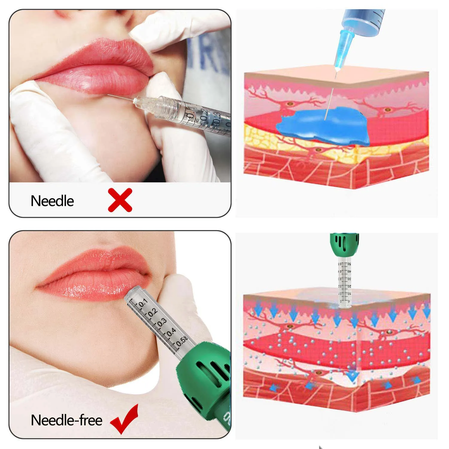 YYR Hot Sale Skin Lip Lifting No Needle Hyaluron Injection Gun Hyaluronic Acid Injector