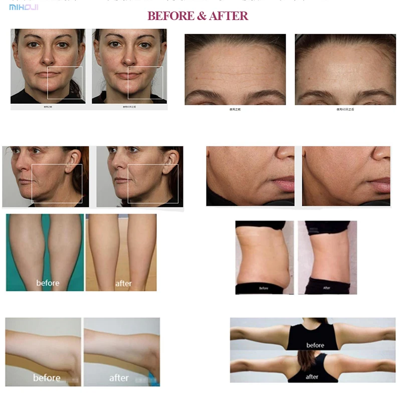Master Fever 448k 360 rotating rf 448khz+20khz deepba RET CET RF Tecar Therapy Fat Burning Weight Loss Body Slimming Machine
