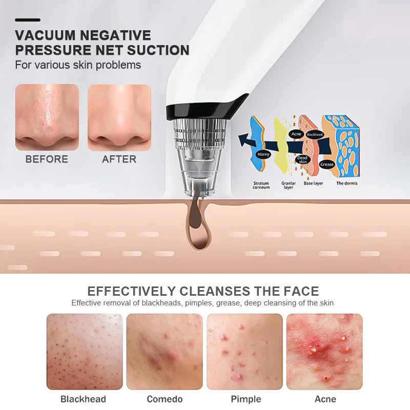 Electric Vibration Vacuum Suction Blackhead Remover Machine Hot and Cold Compress Whitehead Pimple Extractor Face Pore Cleaner