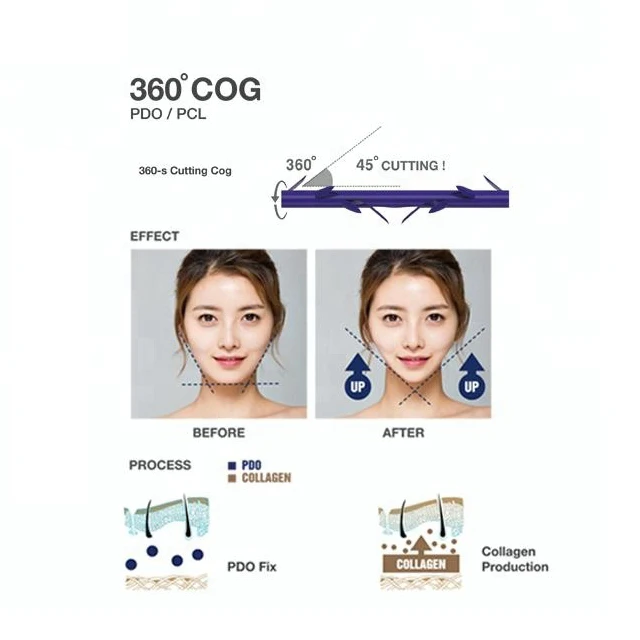 High Quality Face Lift Korean Thread 21g 100mm Cog 4d Hilo De Pdo Thread With Half-Blunt L Cannula