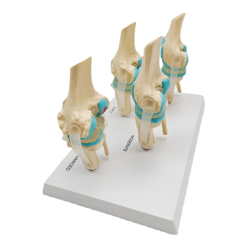Life size human skeleton anatomical bone teaching model 4-stage diseased knee joint model