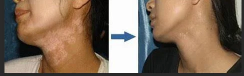 311nm NB UVB Phototherapy UV Lamp Psoriasis Vitiligo Treatment new pad